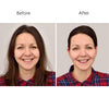 Silicone Anti-Wrinkle Patches